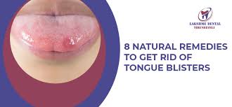 how to get rid of tongue blisters