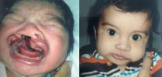 correcting a cleft lip and palate j