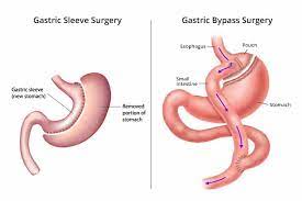 gastric sleeve versus gastric byp a