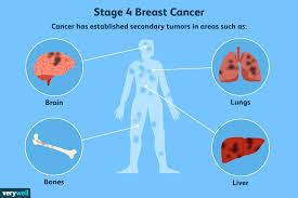 Where Breast Cancer Spreads Common Sites Of Metastasis