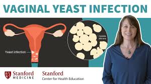 inal yeast infection doctor
