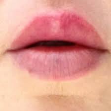 upper lip scar revision what can be