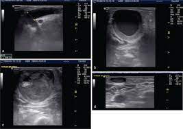 Role of color doppler ultrasound for assessment of arteriovenous fistula  dysfunction in hemodialysis patients Abdelaziz O, Adel Fahmy M, El-Khashab  SO - Kasr Al Ainy Med J