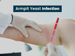 armpit yeast infection symptoms causes