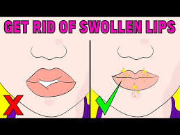 how to fix swollen lips naturally you