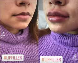 what are lip fillers types of lip