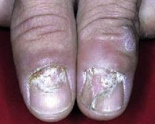 nail involvement in pemphigus vulgaris