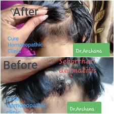 cure homeopathic clinic in pimple