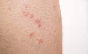 flea bites on human what it looks like