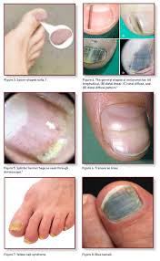 nail conditions of the lower extremity