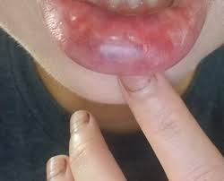 lip filler hit a blood vessel did i