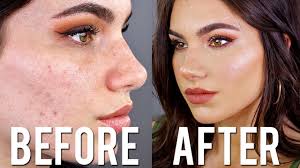 cover acne with makeup