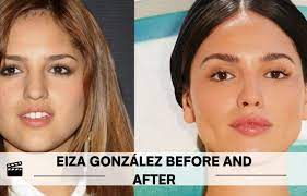 Eiza González Before And After Surgery ...