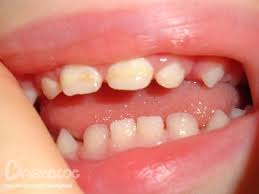 Image result for what is enamel hypoplasia
