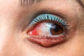blepharitis causes symptoms and