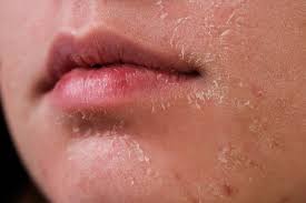 dry skin around mouth symptoms causes