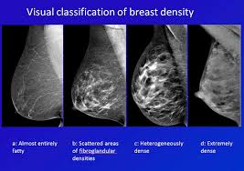 For Patients Michigan Breast Density Notification