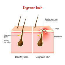 skincleanze ingrown hair treatment