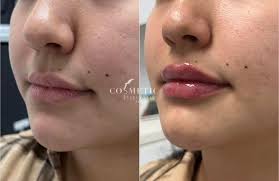 lip filler lip injection botox lip