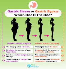 gastric byp vs gastric sleeve a