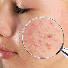 permanent acne scars treatment in