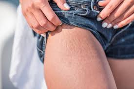 get rid of stretch marks permanently