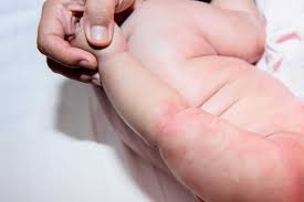 home remes for baby body rash