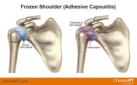 frozen shoulder adhesive capsulitis