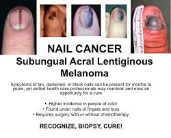 nail cancer 2 kalamazoo residents vow