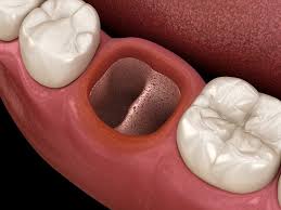 dry socket thrive dental and orthodontics