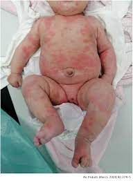 A maculopapular urticarial rash may present as early sign of disease 8 9 10 or during disease 11 without a yet known association to severity. Cutaneous Manifestations In The Current Pandemic Of Coronavirus Infection Disease Covid 2019 Anales De Pediatria
