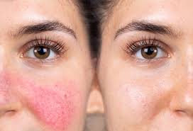 how to get rid of my rosacea the well