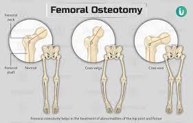 fem osteotomy procedure purpose