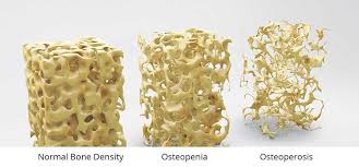 Image result for t-score,Osteoporosis