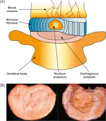 intervertebral disk an overview
