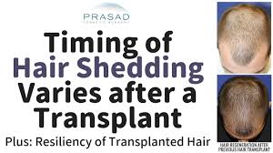 why timing of hair shedding after a