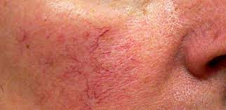 spider veins on face prominence breeds