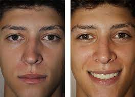 los angeles nose surgery