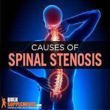 spinal stenosis causes symptoms