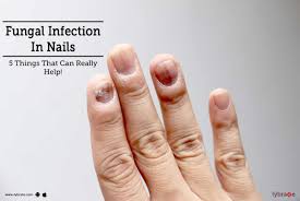 fungal infection in nails 5 things