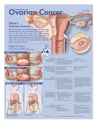 Understanding Ovarian Cancer Laminated Anatomical Chart
