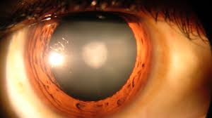 white spot in the eye causes