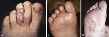 dermatology of the foot and lower