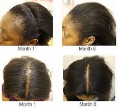 Jamaican black castor oil (jbco) has become a very popular oil to use on the hair and scalp. Rejuvenate Potent Jamaican Black Castor Oil For Traction Alopecia For Sale Online Ebay