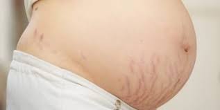 best stretch mark oils and serums in