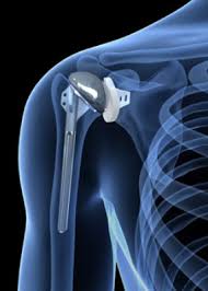 tips to recover from a shoulder surgery
