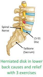 herniated disk in lower back causes and