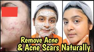 acne pimples acne scars
