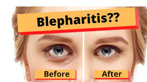 treat blepharitis best home treatment