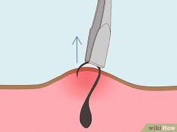 remove ingrown hair on your face